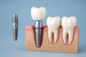 Dental implants closeup showcasing natural-looking artificial teeth and healthy gums
